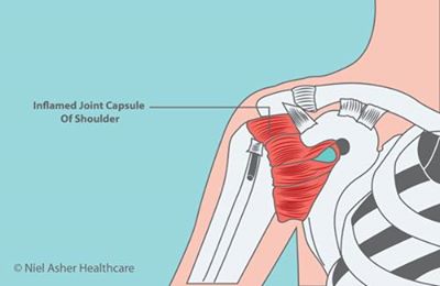 Frozen Shoulder