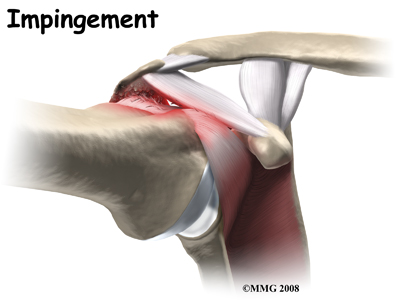 Impingement Syndrome